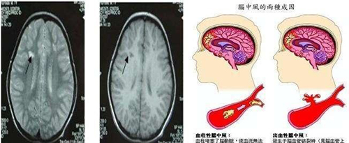 经颅磁治疗仪的作用|怎样预防脑血栓的形成