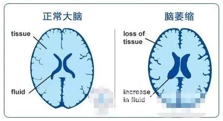 经颅磁治疗仪价格|老人脑萎缩的临床表现是什么?