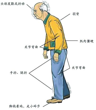 经颅磁刺激治疗仪——帕金森饮食哪些不能吃