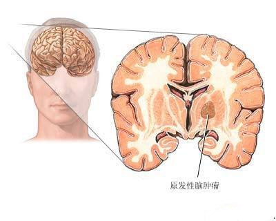 择思达斯经颅磁_得了癫痫会遗传下一代吗