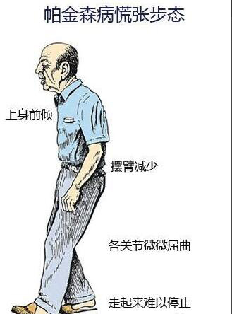 择思达斯品牌经颅磁_帕金森是遗传性疾病吗